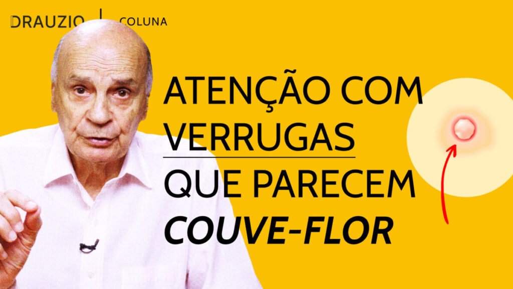 Verrugas nas partes íntimas podem ser sinal de HPV