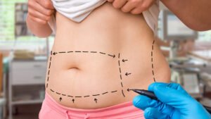 Tipos de lipoaspiração: entenda as diferenças entre lipo tradicional, HD e novas tecnologias