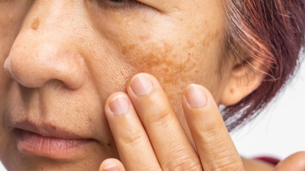 Melasma não tem cura, mas tem controle: conheça os tratamentos