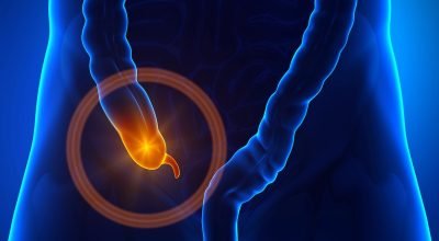 Afinal, para que serve o apêndice e quando ele se torna um problema?