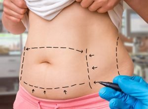 Tipos de lipoaspiração: entenda as diferenças entre lipo tradicional, HD e novas tecnologias