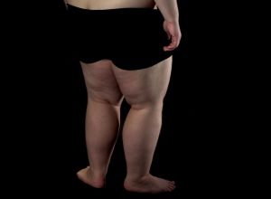 Por que emagrecer não resolve o lipedema?