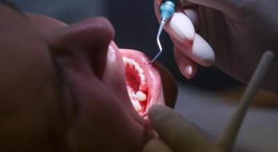 Periodontite é silenciosa e pode afetar a saúde além dos dentes