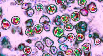 Sarampo confirmado em visitante recente da Disneylândia, – NBC Los Angeles