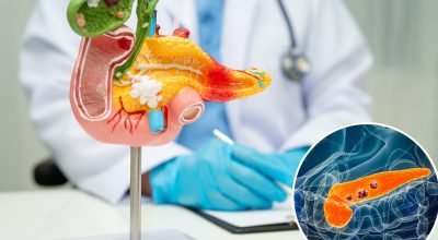 Avanço do câncer de pâncreas: tumores desaparecem em ratos